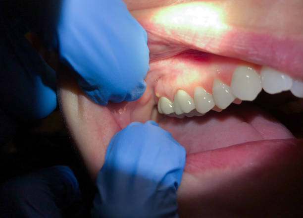 Best Emergency Cosmetic Dentistry (e.g., broken veneers) in St Jaco, IL
